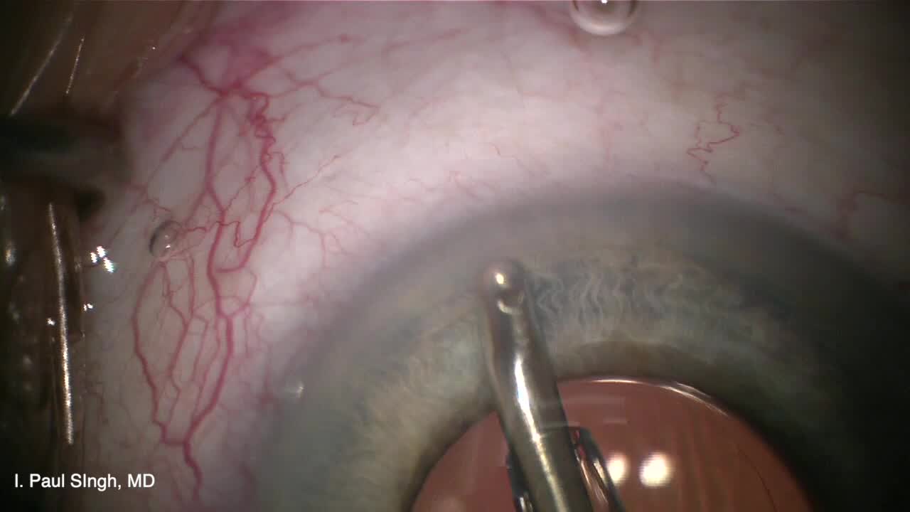Viscodilation and iStent Inject Implantation
