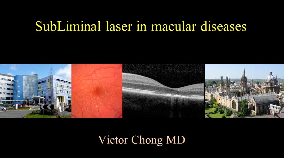 SubLiminal laser in macular diseases