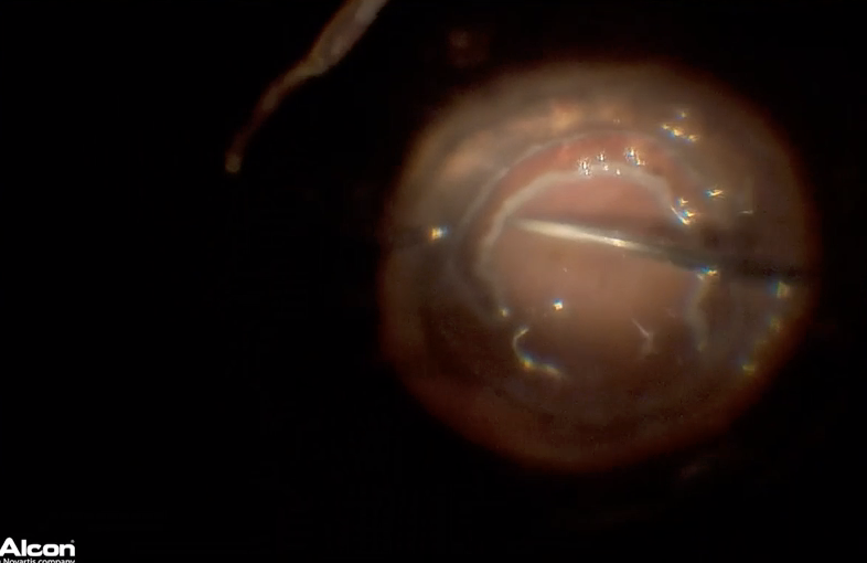PVR & Posterior Tear