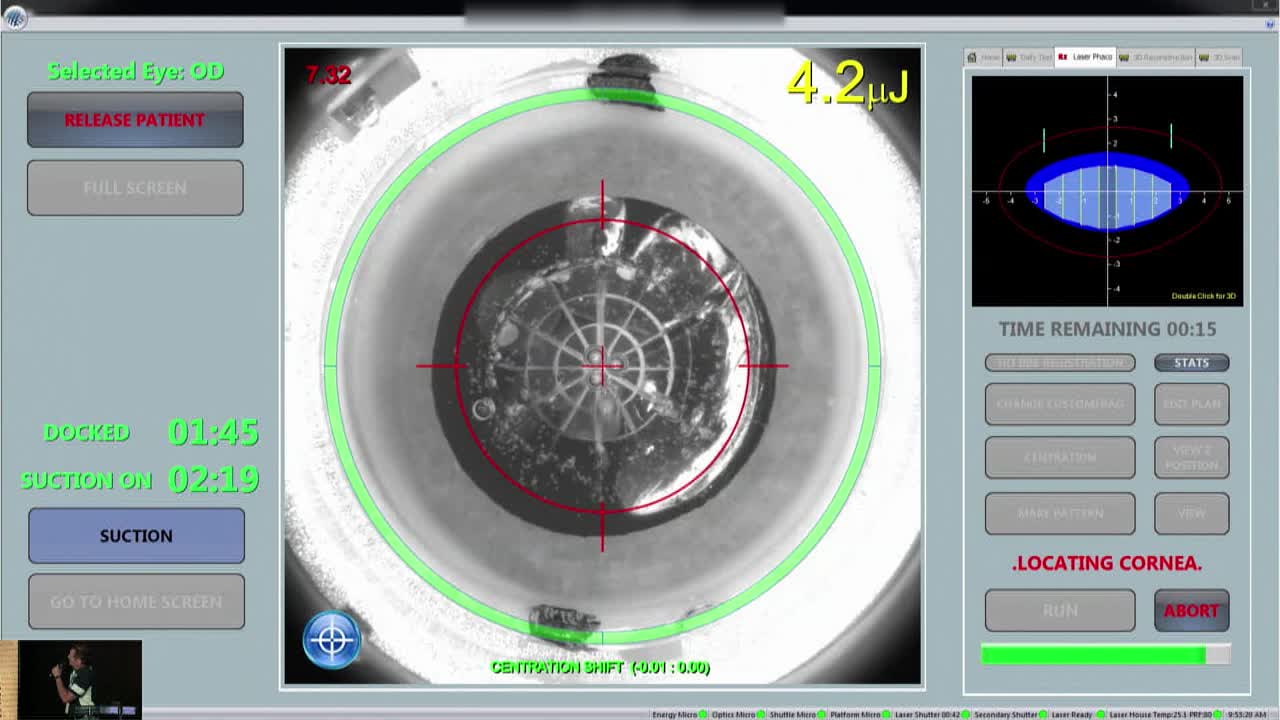 Correct Astigmatism Using the LENSAR System