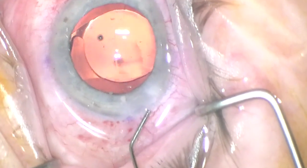 Dexycu Injection Technique