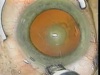 Posterior Polar Cataract Principles