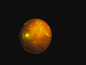 27 G Vitrectomy For Taut Posterior Hyaloid in Proliferative Diabetic Retinopathy