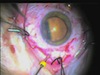 Get Bent: How to Utilize a Surgeon-Bent Vitrector