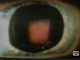 Endocapsular Hematoma