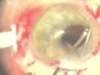 Vitrectomy for Dislocated IOL in the Vitreous Cavity