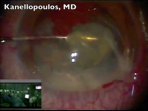Cataract Surgery after PPV with Compromised Posterior Capsule