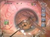OZil IP Torsional Ultrasound with an AcrySof IQ ReSTOR IOL in a Grade 2 Nucleus