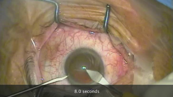 Bimanual Simultaneous Corneal Incisions Plus Capsular Puncture