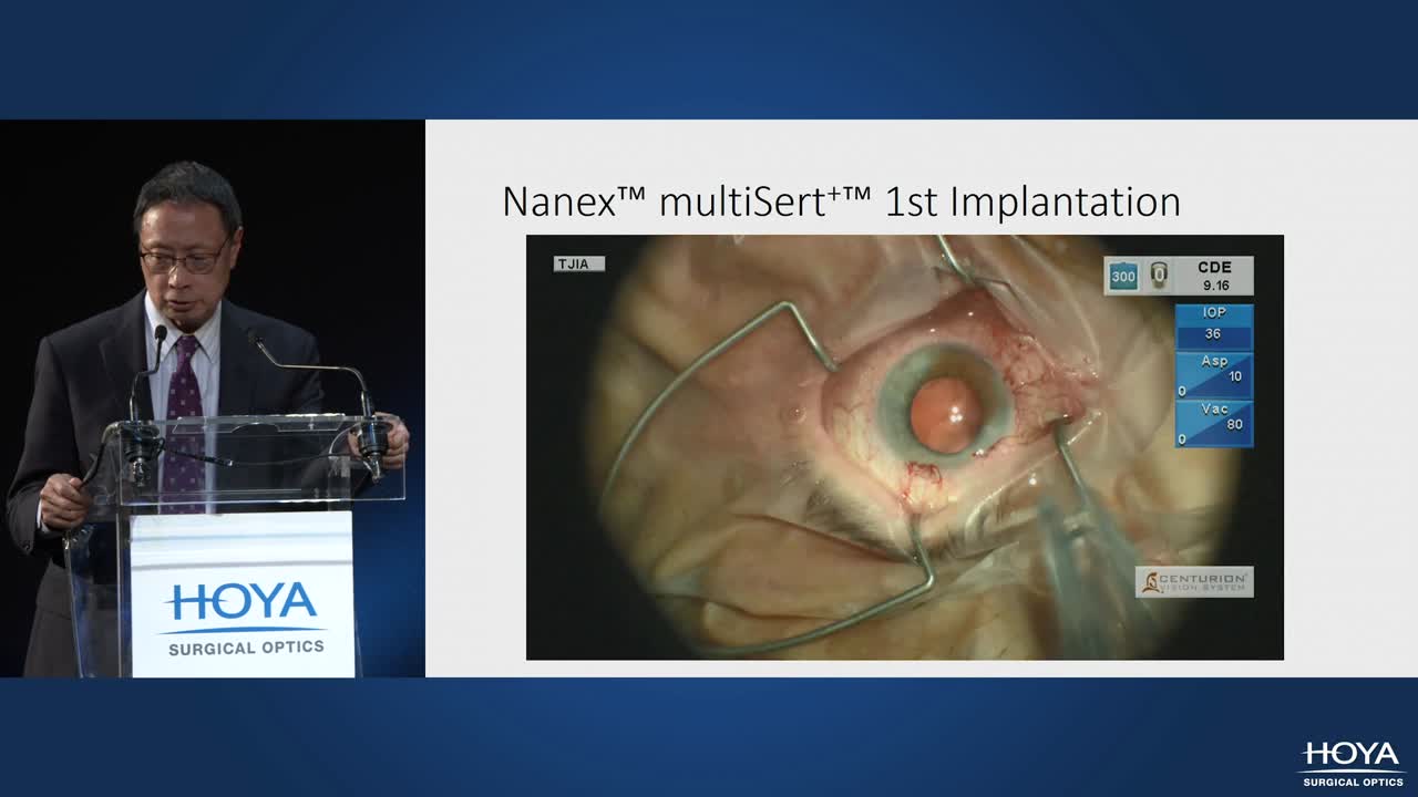First Clinical Impressions of the Nanex multiSert