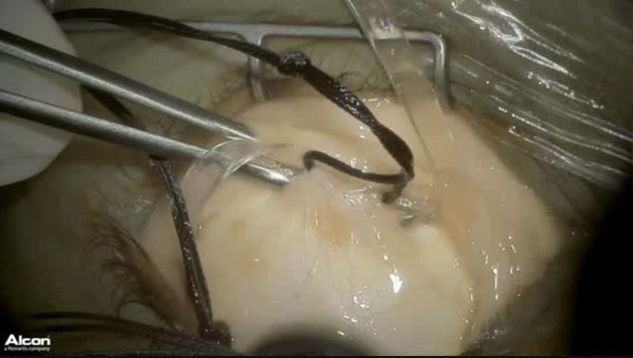 Retinal Detachment Secondary to Stickler Syndrome (Part 1)