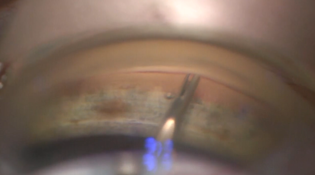 iStent inject Procedure Teaching Video