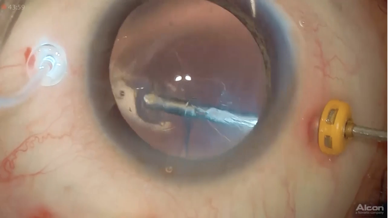 Macular Hole Retinal Detachment