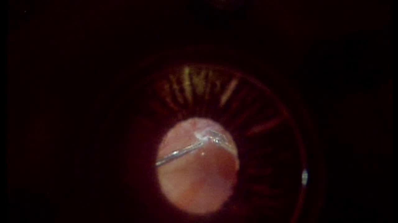 Tractional Retinal Detachment in Proliferative Diabetic Retinopathy