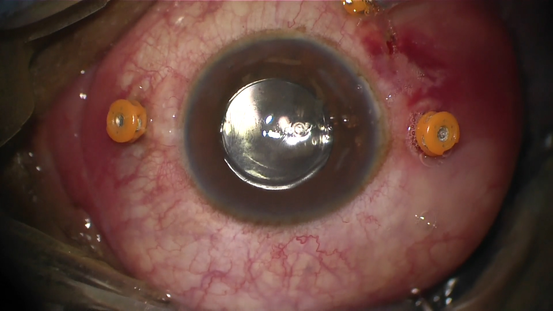 Giant Retinal Tear and Retinal Detachment