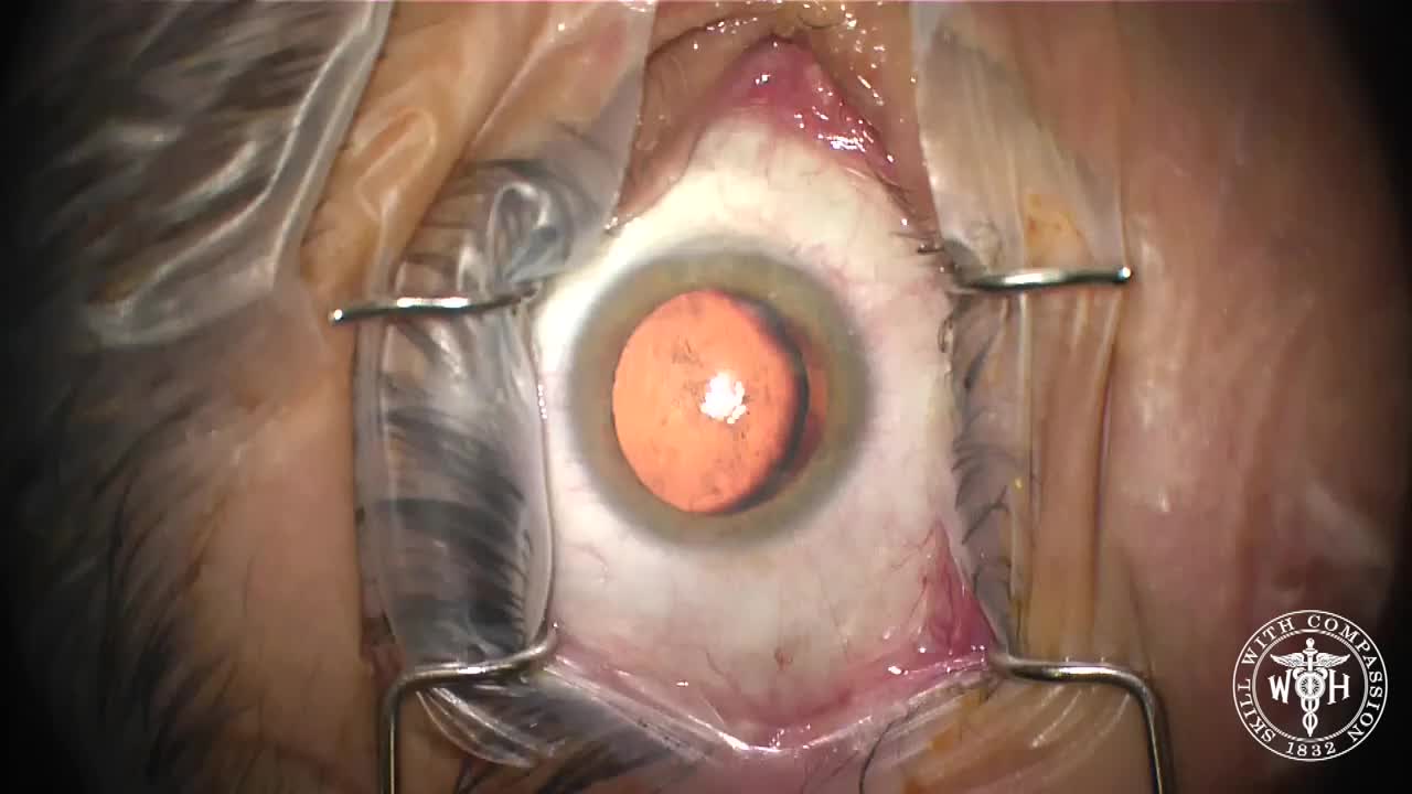 Airbag Induced Traumatic Cataract Removal