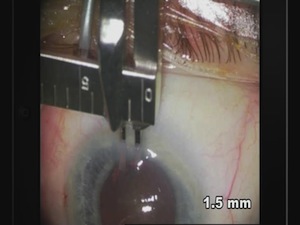 Cross-action Forceps