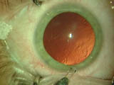 Bilateral Visian ICL placement