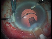 Glued IOL Live Surgery