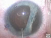 Traumatic Cataract Caused by a Blunt Injury
