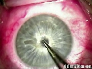 Corneaplastique for Keratoconus with Corneal Scar