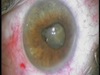 PFC Flotation of a Dropped Mature Cataract