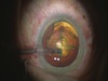 PhacoFirst Technique in Femtosecond Cataract Surgery