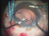 Live Glued IOL Surgery