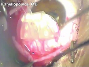 Aphakic Pediatric Glaucoma