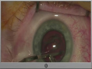 The Rock'n Roll Femto Cataract Surgery