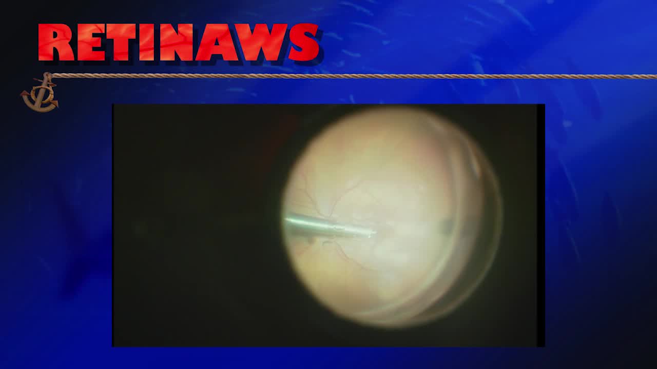 Macular Hole