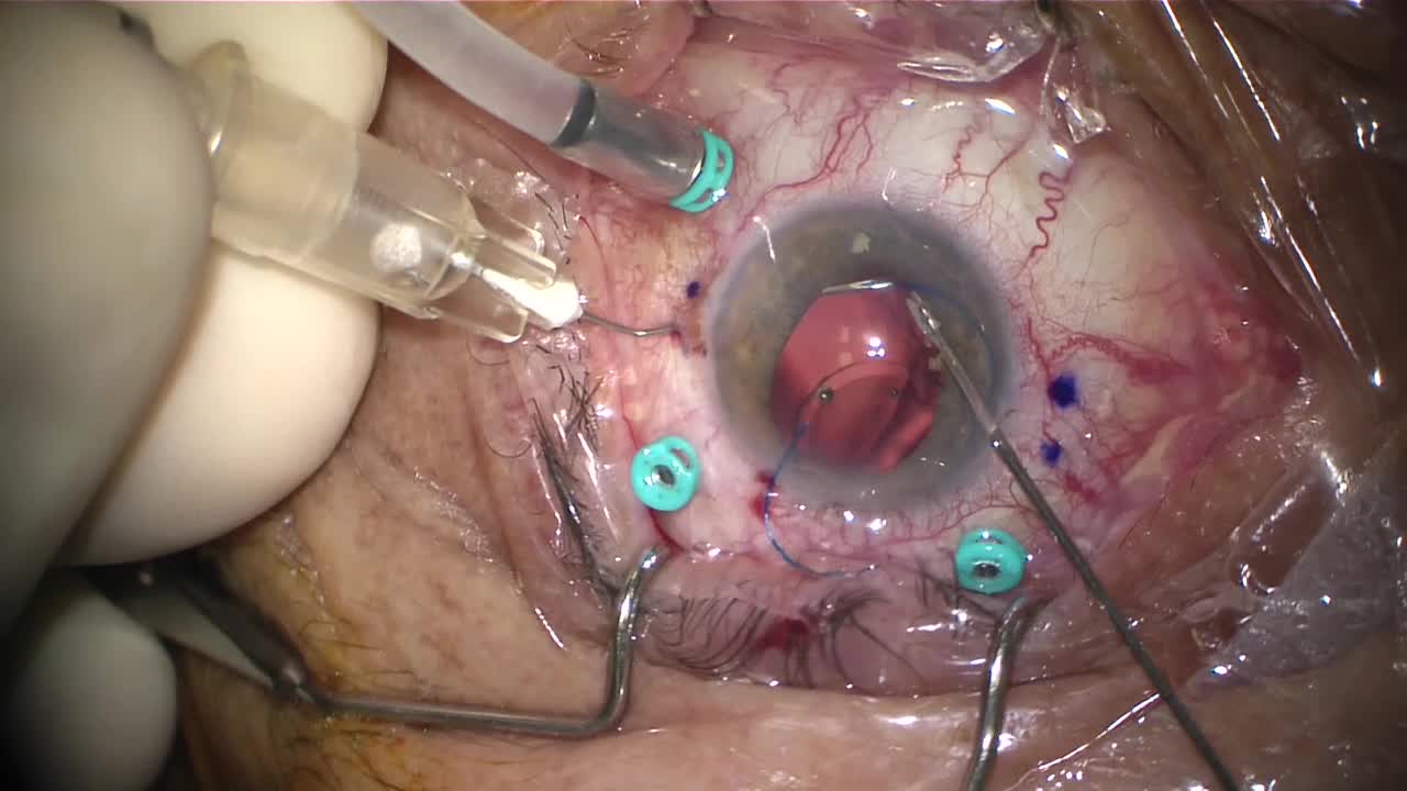 30 Gauge Needle IOL Fixation