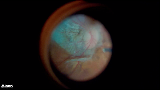 Contrast-Enhanced ILM Peeling