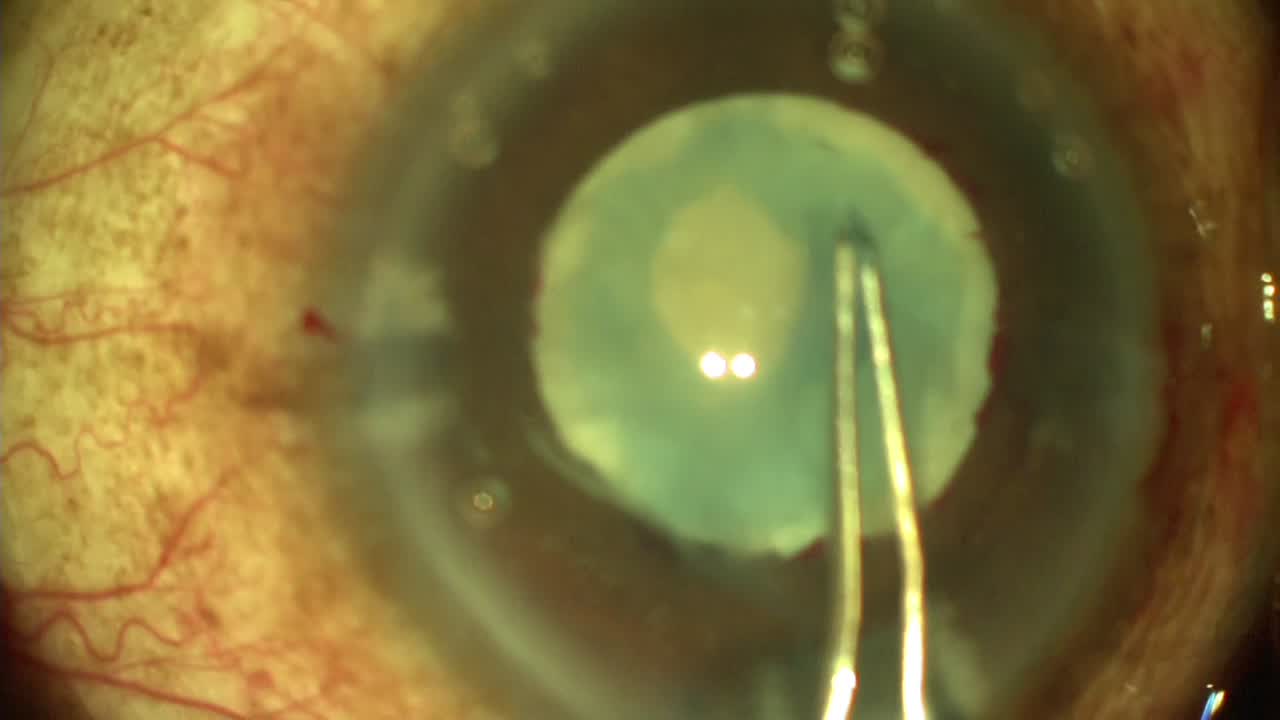 Dense Cataracts in a Patient With HIV, Progressive Outer Retinal Necrosis, and Silicone Oil