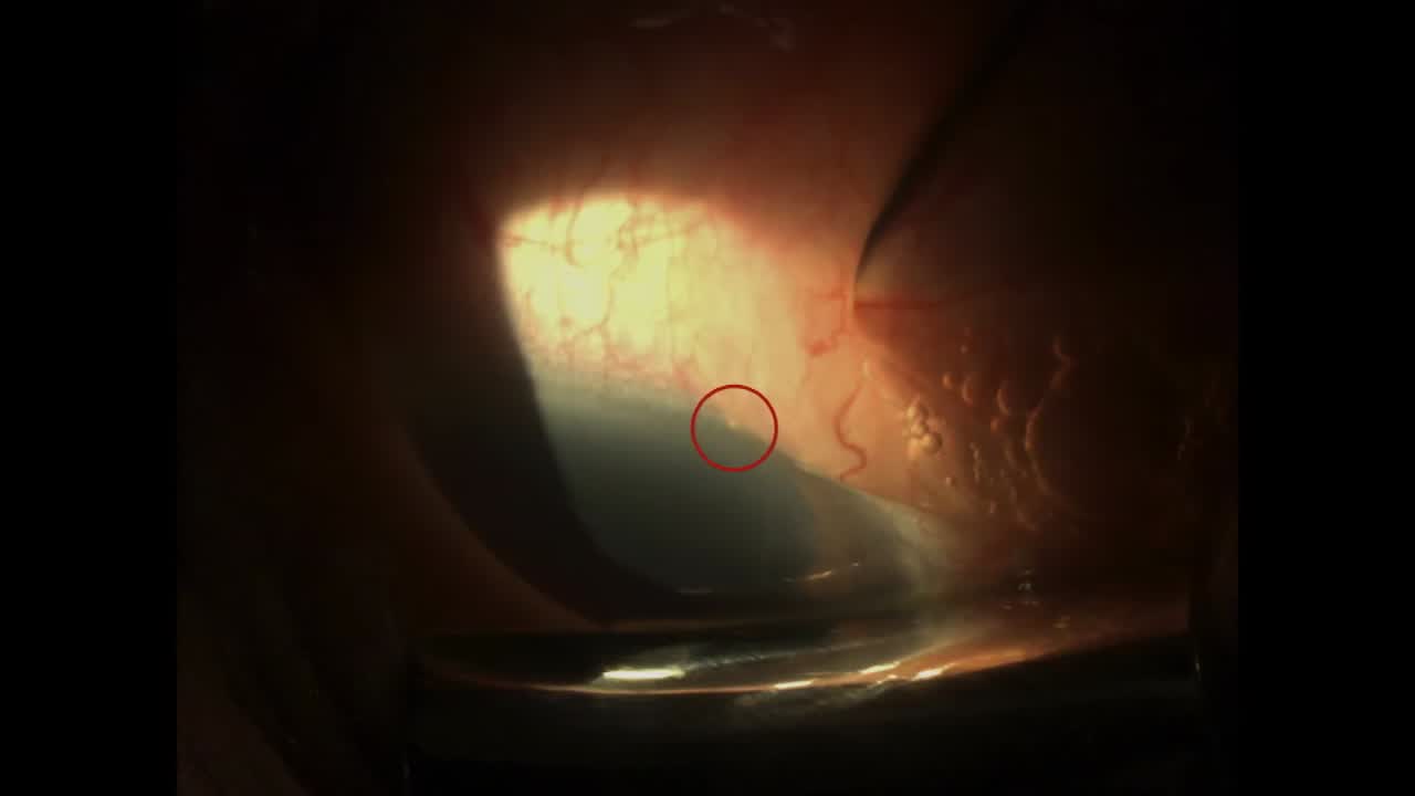 Xen Implantation at the Slit Lamp