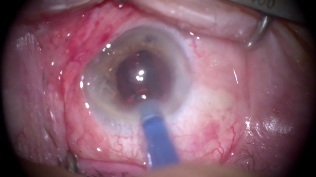 A Routine Cataract Surgery Case