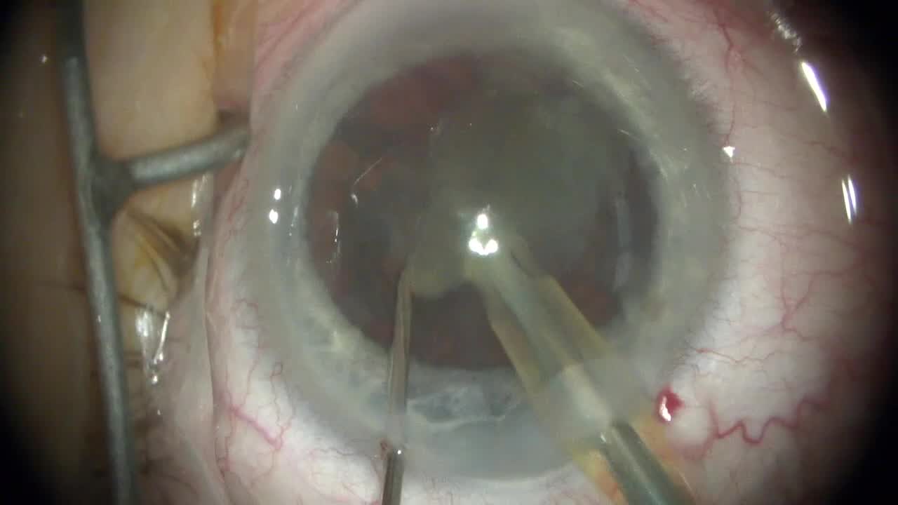 Peristaltic to Venturi AMO SP with VO