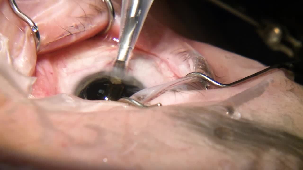 Full Surgical Case Featuring the INTREPID TRANSFORMER I/A System