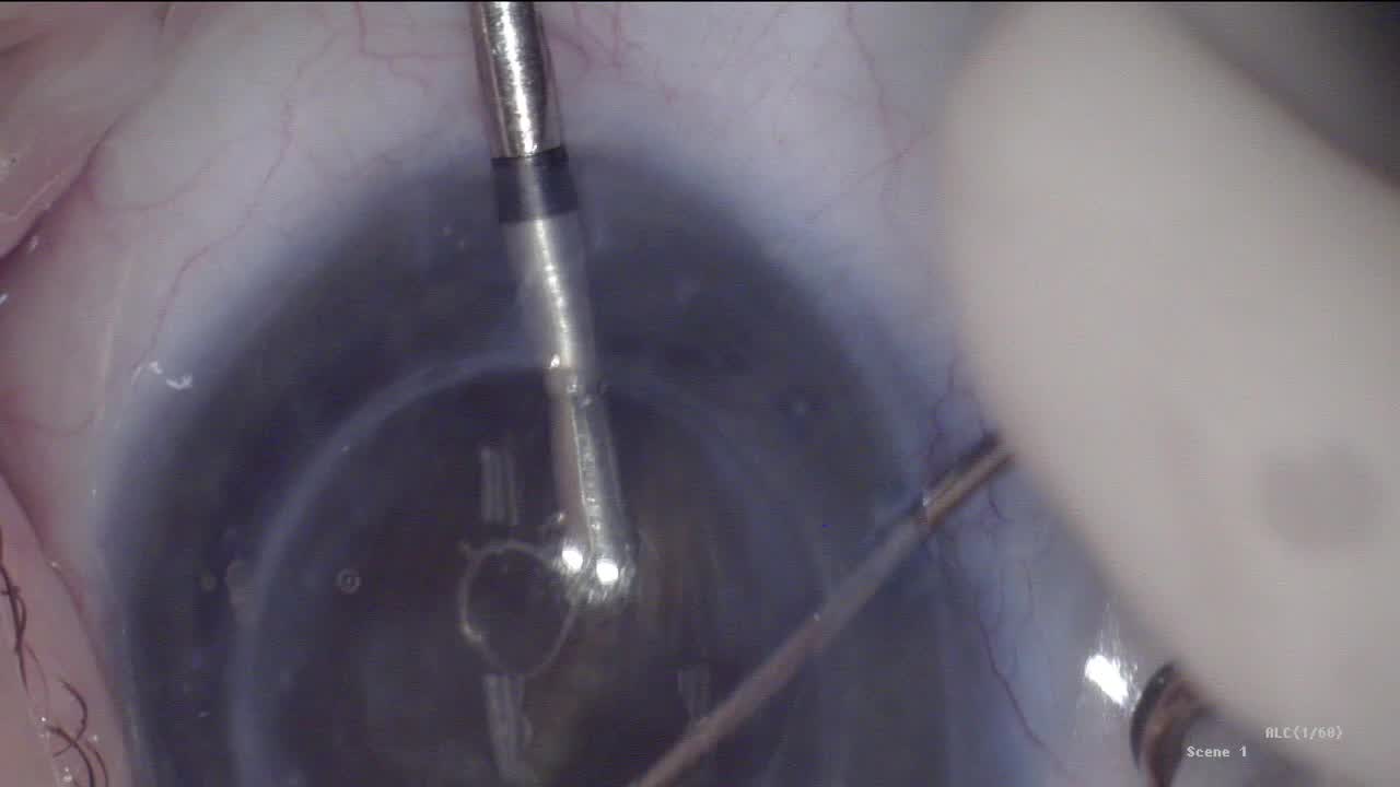 miLoop in a Brunescent Cataract