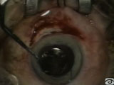 Laser Damaged IOL Exchange