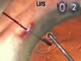 Capsular Tension Segment (CTS)