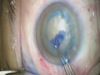 Managing a Traumatic White Cataract with OVDs