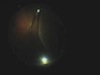 25-Gauge Giant Retinal Tear Vitrectomy Using DORC Associate System