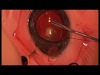 Pediatric IOL with PPV
