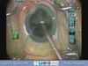 OZil IP With a Grade 4+ Cataract