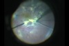 27-gauge Macular Surgery for DME