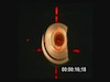 LASIK with Femtosecond LDV laser