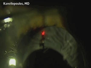 Nd:YAG Laser for Anterior Capsular Phimosis