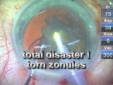 Iatrogenic Zonular Disaster