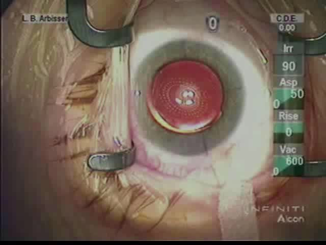 Forward Optic Capture of a Rotated Toric IOL